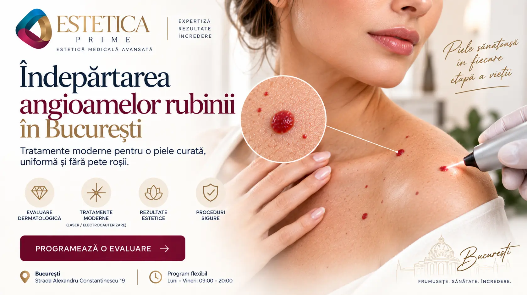 Îndepărtarea angioamelor rubinii în București – evaluare dermatologică la Estetica Prime