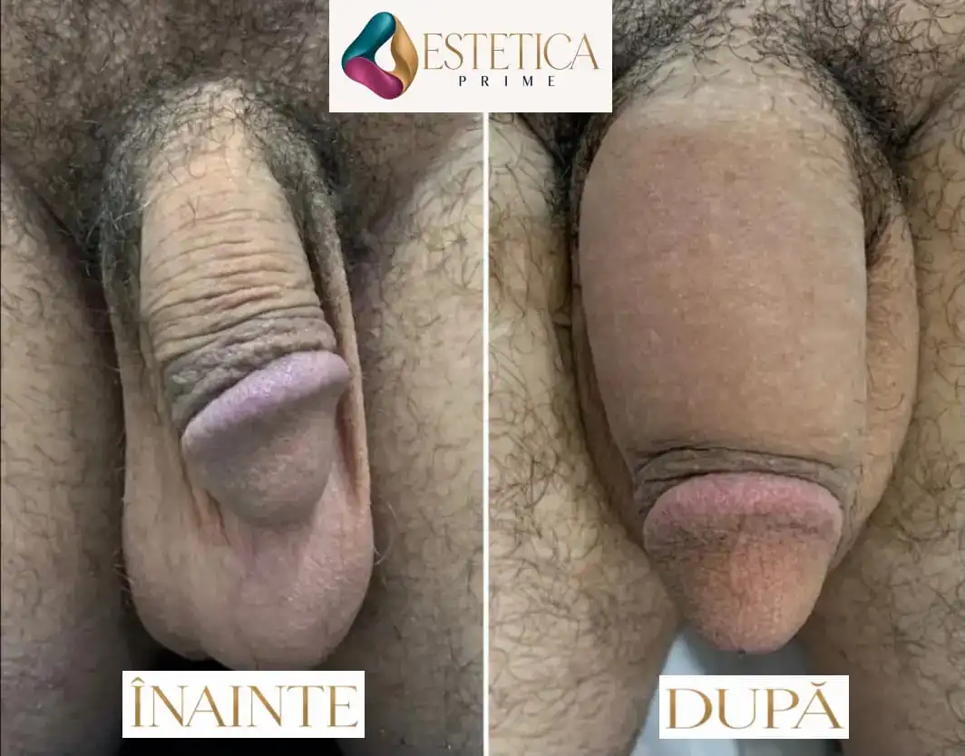 Înainte și după mărirea și îngroșarea penisului cu acid hialuronic – Estetica Prime